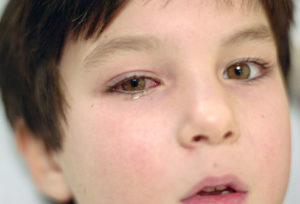 alergii oculare ochi rosii